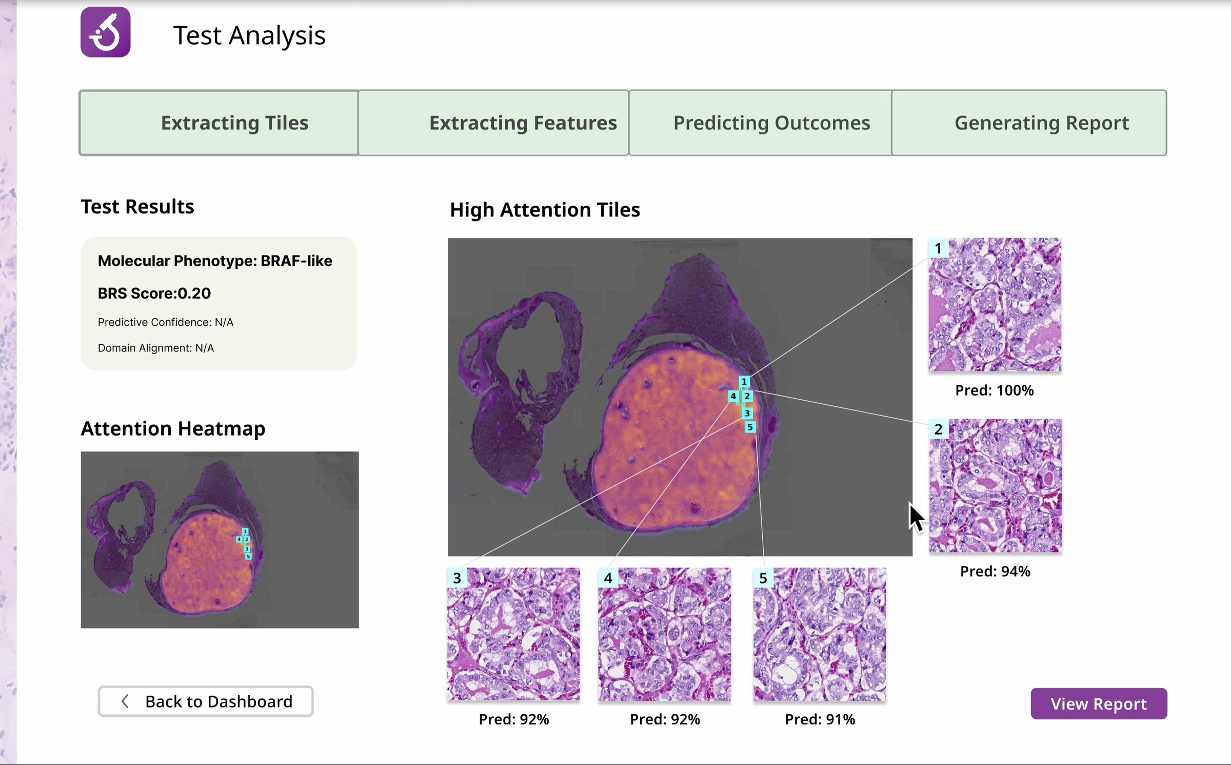 Final prototype: test analysis view with attention heatmap and high-attention tiles surfacing the model's evidence